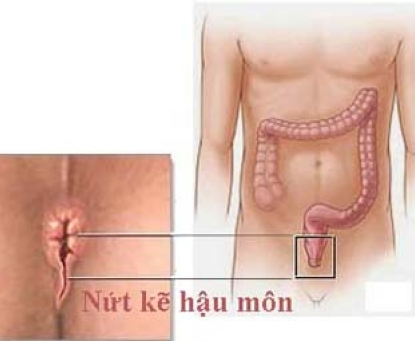 Tổng quan bệnh nứt kẽ hậu môn